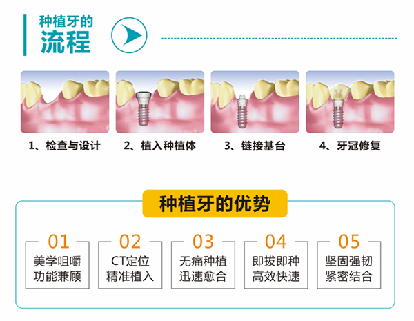 娄底协合口腔医(yī)院做种植牙流程